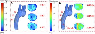 Full-scale numerical simulation of hemodynamics based on left ventricular assist device